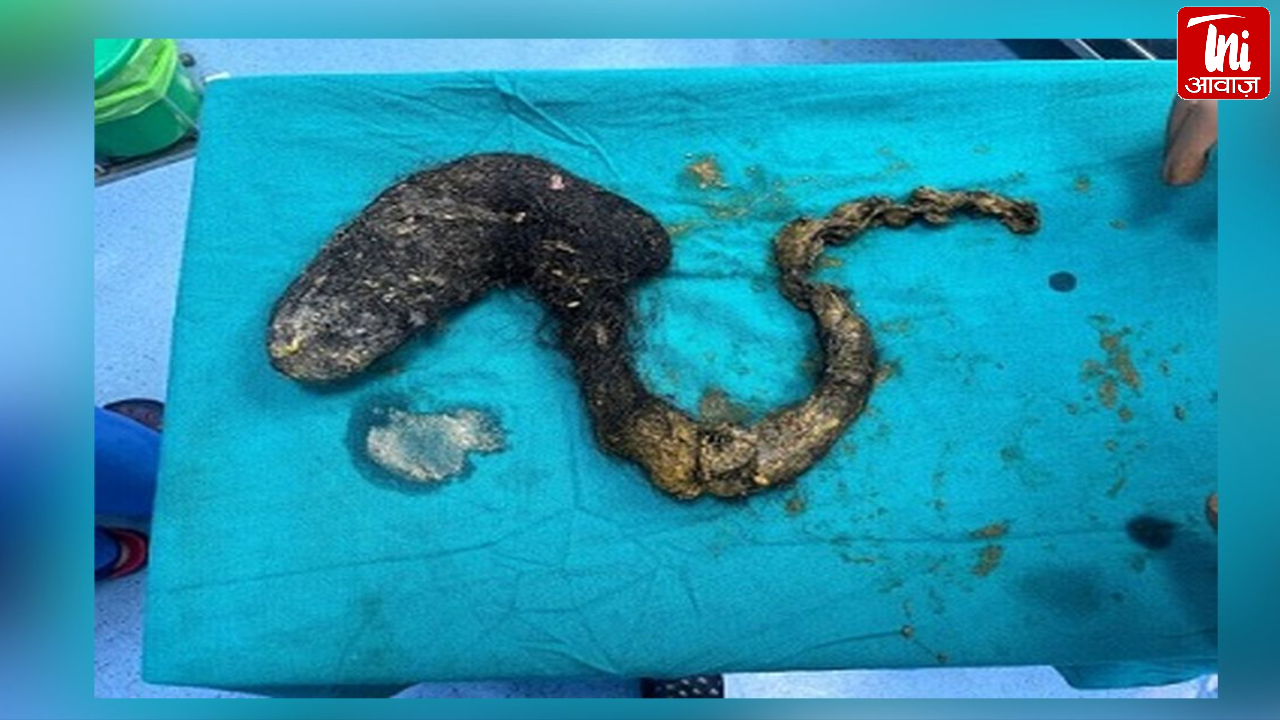 एम्स जोधपुर में चौंकाने वाला केस, 20 वर्षीय युवती के पेट से 62 सेमी बालों का गुच्छा निकला